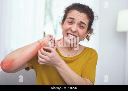 Young sick lady suffering from allergic rash Stock Photo