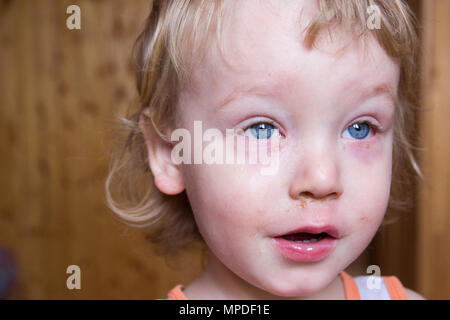 Little boy with blond hair and blue eyes suffering from disease conjunctivitis. Virus struck their eyes, they were red and swollen. Stock Photo