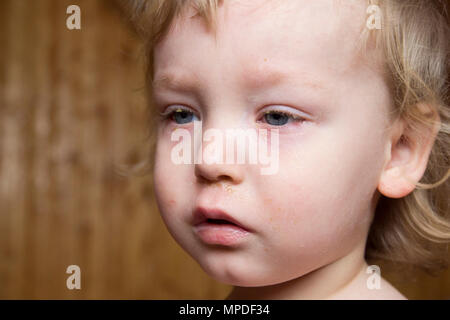 Little boy with blond hair and blue eyes suffering from disease conjunctivitis. Virus struck their eyes, they were red and swollen. Stock Photo