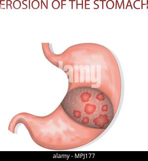 illustrations of the erosion of the stomach Stock Vector