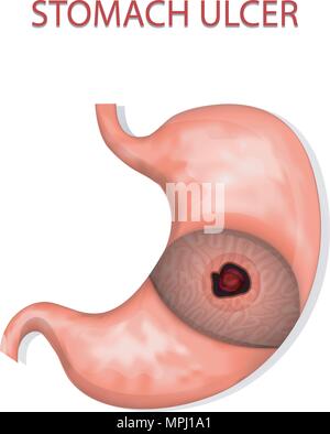 illustration of the stomach ulcers.  gastroenterology. gaster Stock Vector
