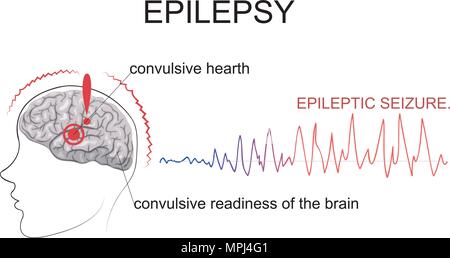 ILLUSTRATED TWO MAIN FACTORS NECESSARY FOR THE OCCURRENCE OF A SEIZURE. THE CENTER OF EXCITEMENT AND GENERAL CONVULSIVE READINESS OF THE BRAIN. Stock Vector