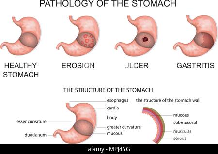 pathology of the stomach. anatomy of the stomach Stock Vector