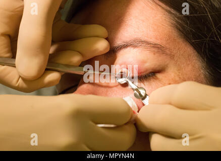 Healthcare concept - Chalazion during eye examination and operation - Female Stock Photo