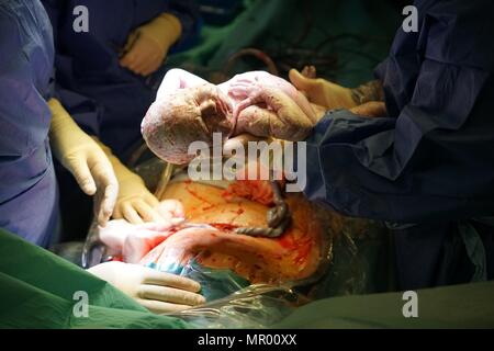 Baby being born by Caesarean section in hospital, covered in vernix, umbilical cord still attached and mother’s surgical wound in background Stock Photo