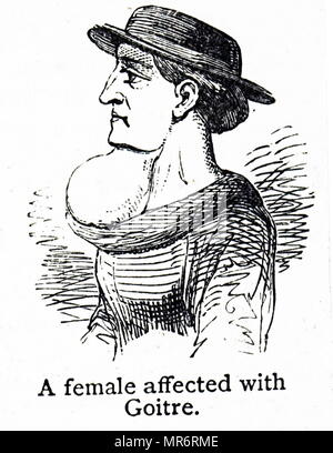 Engraving depicting a woman affected with Goitre. Goitre is the swelling of the neck resulting from an enlarged thyroid gland. Dated 19th century Stock Photo