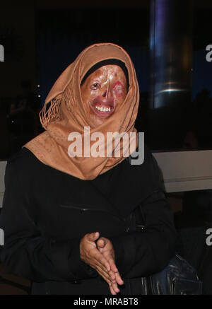 Los Angeles, California, USA. 25th May, 2018. Hamama, at Face Forward & The Children's Burn Foundation Brings Syrian Burned Victims To Los Angeles For Reconstructive Surgeries at LAX Airport in Los Angeles, Californialifornia on May 25, 2018. Credit: Faye Sadou/Media Punch/Alamy Live News Stock Photo