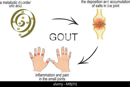 Gout Racgp the mechanism of development of gout. pain in the joints Stock Vector ...