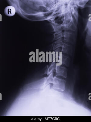 X-ray of neck, lateral projection. Cervical sprain rectification of lumbar lordosis Stock Photo