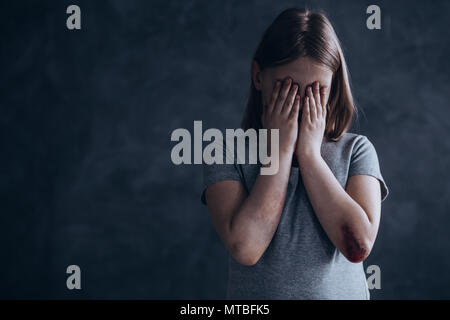 Little girl with bruises covering face with her hands Stock Photo