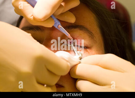 Healthcare concept - Chalazion during eye examination and operation - Female Stock Photo