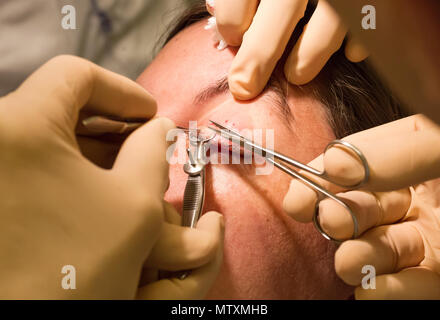 Healthcare concept - Chalazion during eye examination and operation - Female Stock Photo