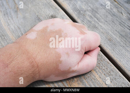 Vitiligo skin condition Stock Photo - Alamy