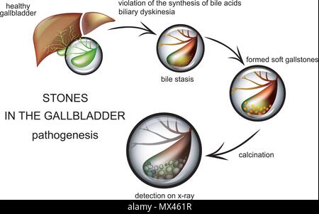 illustration of gallstone disease. the pathogenesis of the disease Stock Vector