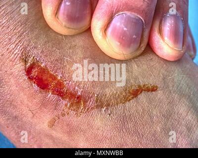 Doctors hand healing a burned skin area.  Hand embracing injured  place with painful abrasion scratches from accident. Stock Photo