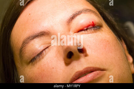 Healthcare concept - Chalazion during eye examination and operation - Female Stock Photo