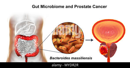 Gut microbiome and prostate cancer. Conceptual illustration showing the association of Bacteroides massiliensis bacteria in the large intestine with prostate cancer development.