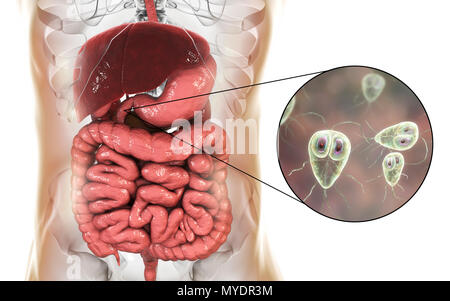 Giardia lamblia in the human duodenum, computer illustration. Giardia lamblia is single-celled protozoan that has flagellae for motility. It causes the disease giardiasis (or lambliasis), an infection of the small intestine most common in tropical areas. Giardia lamblia attaches by means of sucking discs to microvilli in the human intestine. Abdominal cramps, bloating, diarrhoea and nausea may occur. The organism is spread by direct contact or through contaminated food and water. Stock Photo