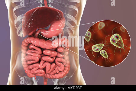 Giardia lamblia in the human duodenum, computer illustration. Giardia lamblia is single-celled protozoan that has flagellae for motility. It causes the disease giardiasis (or lambliasis), an infection of the small intestine most common in tropical areas. Giardia lamblia attaches by means of sucking discs to microvilli in the human intestine. Abdominal cramps, bloating, diarrhoea and nausea may occur. The organism is spread by direct contact or through contaminated food and water. Stock Photo