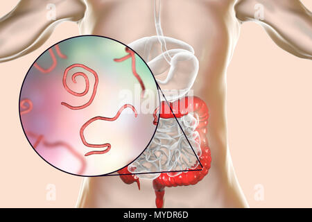 Threadworm infection. Computer illustration showing multiple threadworms (Enterobius sp.) in the human intestine. Threadworms are nematode worms that parasitize the large intestine and caecum of many animals. In humans they cause the common infection enterobiasis. Nematodes are unsegmented worms that may be parasitic or free-living depending upon the species. Stock Photo