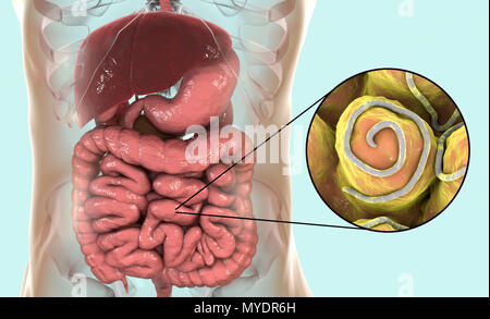 Threadworm infection. Computer illustration showing multiple threadworms (Enterobius sp.) in the human intestine. Threadworms are nematode worms that parasitize the large intestine and caecum of many animals. In humans they cause the common infection enterobiasis. Nematodes are unsegmented worms that may be parasitic or free-living depending upon the species. Stock Photo