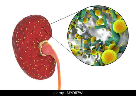 Acute pyelonephritis. Illustration of small abscesses (yellow) on the ...
