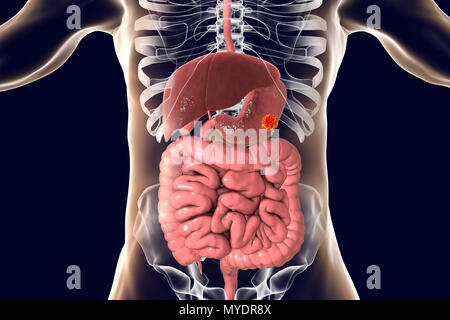 Human food pipe (oesophagus) with tumour computer artwork Stock Photo ...