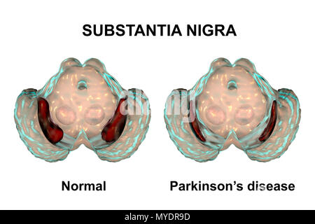 Substantia nigra. Computer illustration showing a healthy substantia nigra (top) and degenerated substantia nigra (bottom) from human brains. The substantia nigra plays an important role in reward, addiction, and movement. Degeneration of this structure is characteristic of Parkinson's disease. Stock Photo