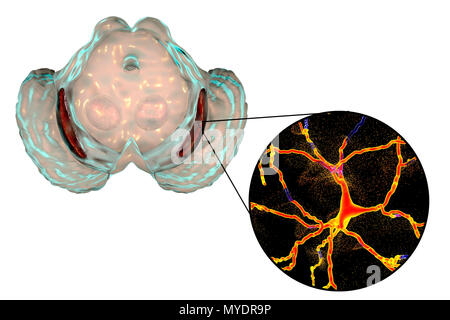 Substantia nigra. Computer illustration showing a degenerated substantia nigra in Parkinson's disease. The substantia nigra plays an important role in reward, addiction, and movement. Degeneration of this structure is characteristic of Parkinson's disease. Stock Photo