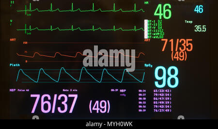 A monitor with a black screen showing a slow heart rate on the ECG, low blood pressure on the arterial line and oxygen saturation on the blue line. Stock Photo