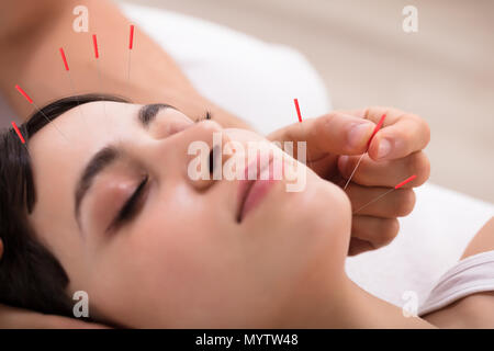 Beautiful Young Woman Getting Acupuncture Treatment In Beauty Spa Stock Photo