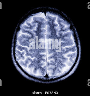Snapshot of the brain in cross section in magnetic resonance imaging Stock Photo