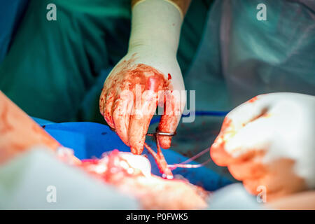 Surgeon sewing and putting stitches after operation, particularly after giving birth Stock Photo