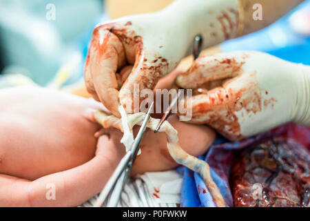Father cuts the umbilical cord between a newborn baby and placenta Stock Photo