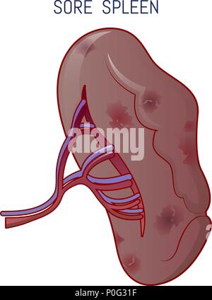 MONONUCLEOSIS, PHARYNGITIS Stock Photo - Alamy