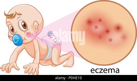 A Vector of Baby Having Eczema Stock Vector Image & Art - Alamy