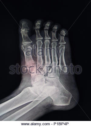 broken toe X Ray Stock Photo: 33492638 - Alamy