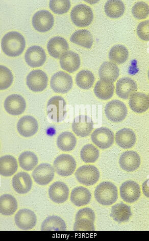 red blood cells infected with the malaria parasite. Plasmodium vivax. Stock Photo