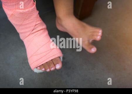 Children wearing a splint of leg broken from injury. Stock Photo