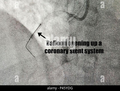 An x-ray displays a coronary stent system being deployed via balloon in the Right Coronary Artery of a patient during an ST- Segment Elevation Myocardial infarction, or STEMI, procedure at the catheterization laboratory, William Beaumont Army Medical Center, June 29. WBAMC currently holds the fastest door-to-balloon times in the Department of Defense and the City of El Paso, Texas, averaging 50 minutes over the last two years. Door-to-balloon time is the measurement of time necessary from the point of patient arrival to the point a catheter with a small balloon is deployed placing a coronary s Stock Photo