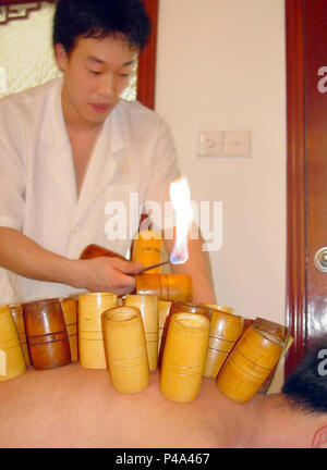 (180621) -- BEIJING, June 21, 2018 (Xinhua) -- File photo taken on May 6, 2004 shows a doctor practicing cupping for a citizen at Shun'antang, a traditional Chinese medicine hospital, in Guangzhou, capital of south China's Guangdong Province. Traditional Chinese medicine (TCM), one of the world's oldest forms of medicine with different practices including acupuncture, bee-sting therapy, cupping, moxibustion, scrapping, tui na (Chinese therapeutic massage), still prevails in the modern society after thousands of years of evolution, during which generations have restored and maintained health Stock Photo