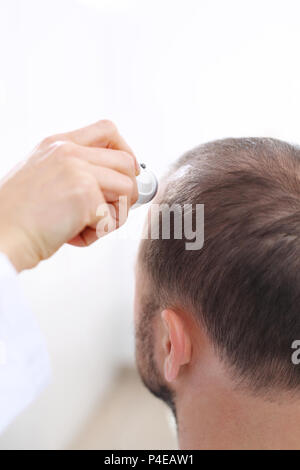 Needle mesotherapy of the scalp. Microneedle mesotherapy of the scalp. The  head of a man with thinning hair during needle mesotherapy Stock Photo -  Alamy