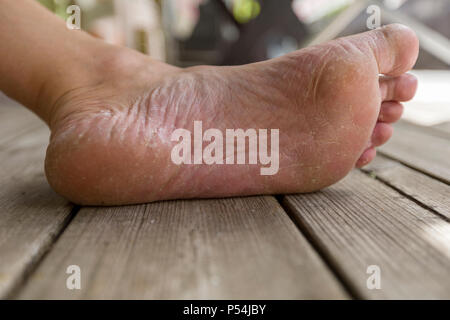 Close up view of adult man's bad athlete's foot and dry cracked heel Stock Photo