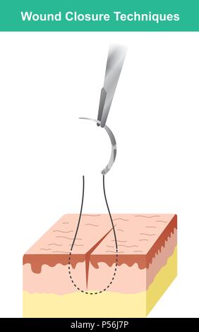 Wound is a type of injury which happens relatively quickly in which skin is torn, cut, or punctured or where blunt force trauma causes a contusion. Stock Vector