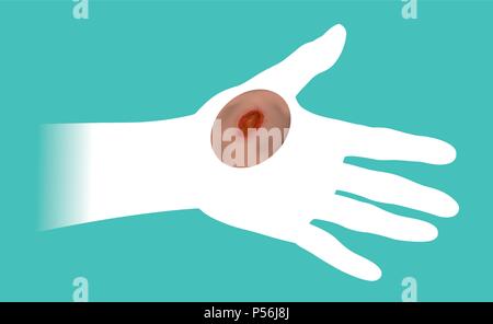 The hands that get hurt by the wound. Illustration info graphic. Stock Vector