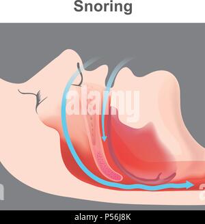 Snoring is the vibration of respiratory structures and the resulting ...