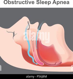 Snoring is the vibration of respiratory structures and the resulting ...