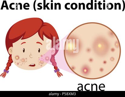 A Young Girl Having Acne illustration Stock Vector