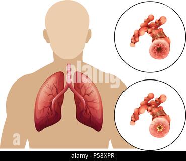 Chronic Obstructive Pulmonary Disease : COPD - Pulmonary Emphysema ...