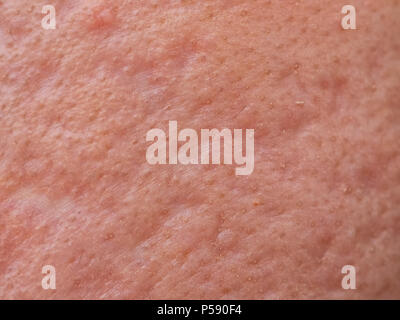 closeup skin problems, nodular cystic acne skin Stock Photo